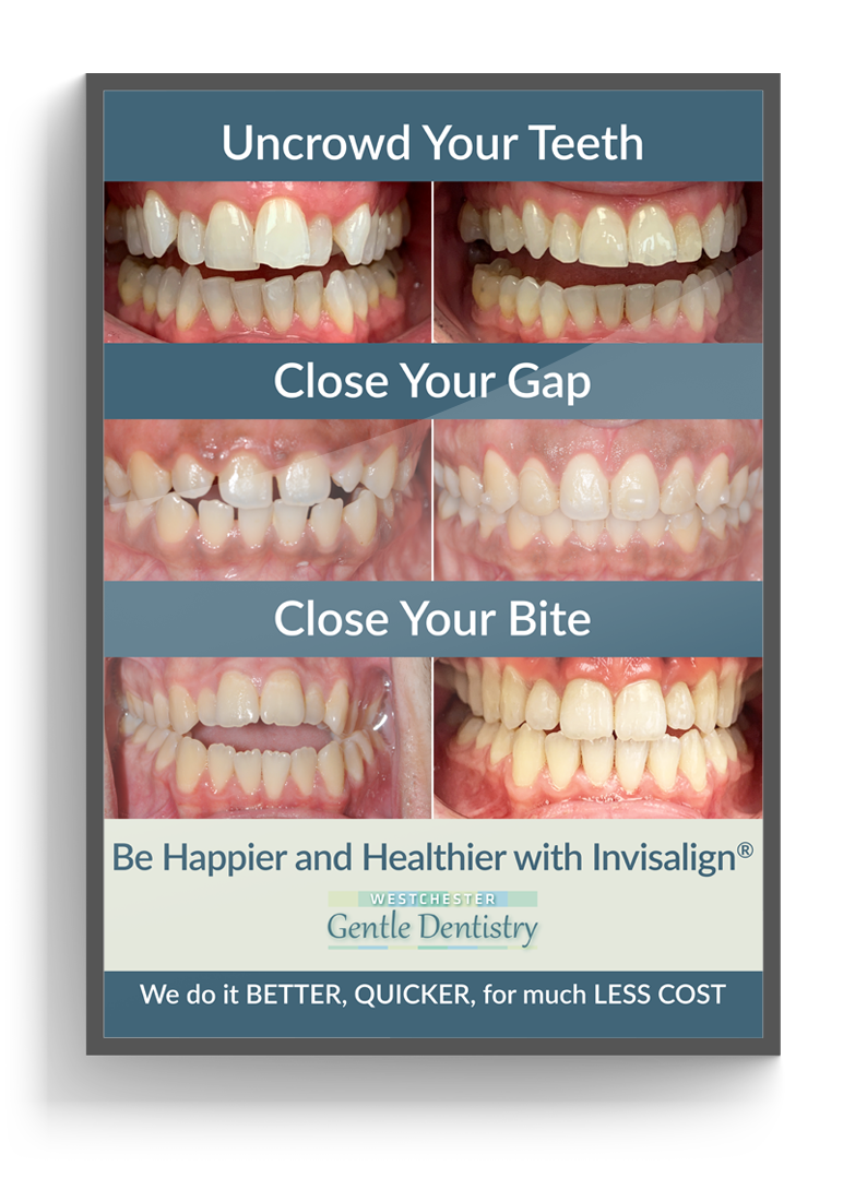 Picture of Invisalign® promotional poster